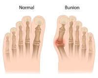 What Caused My Bunion?