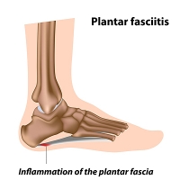 Heel and Arch Pain May Indicate Plantar Fasciitis