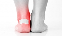 Treating Friction Blisters on Feet